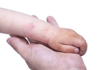 eczema on the skin of a baby